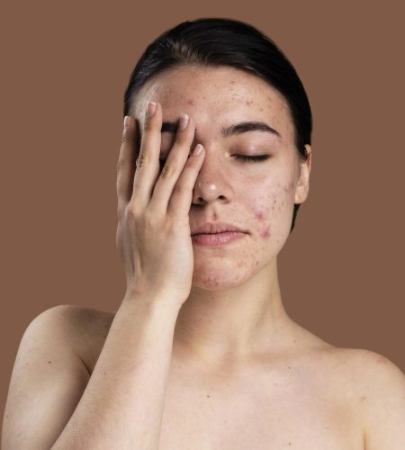 portrait-young-woman-being-confident-with-her-acne